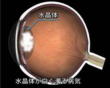 白内障 どんな病気? 白内障 どんな病気?