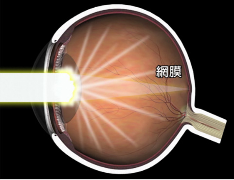 白内障 どんな病気? 白内障 どんな病気?