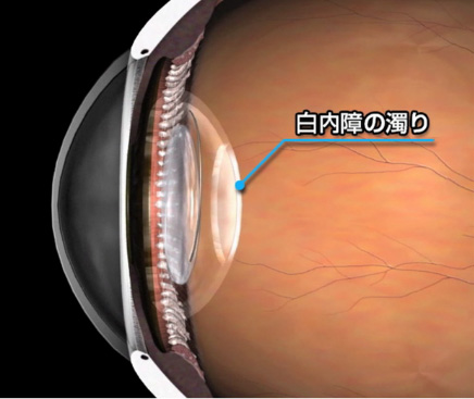 水晶体嚢にレーザー 水晶体嚢にレーザー