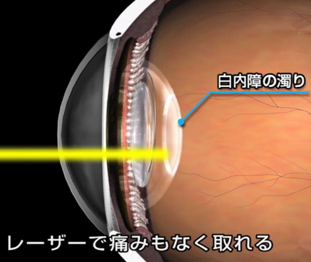 水晶体嚢にレーザー 水晶体嚢にレーザー