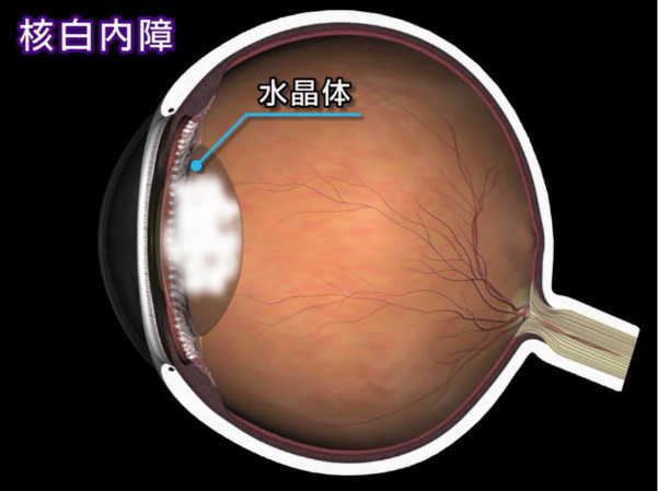 皮質白内障 皮質白内障