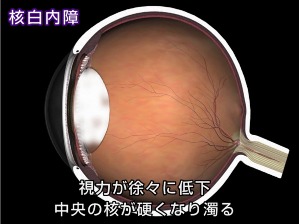 皮質白内障 皮質白内障