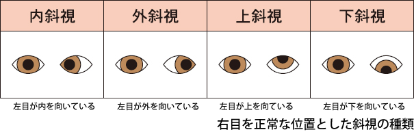 斜視の種類 斜視の種類