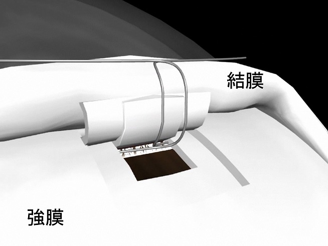 流出路再建術(トラベクロトミー)とは