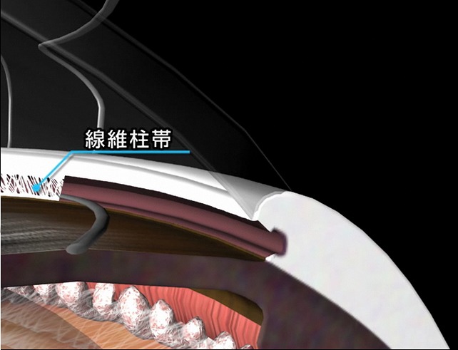流出路再建術(トラベクロトミー)とは