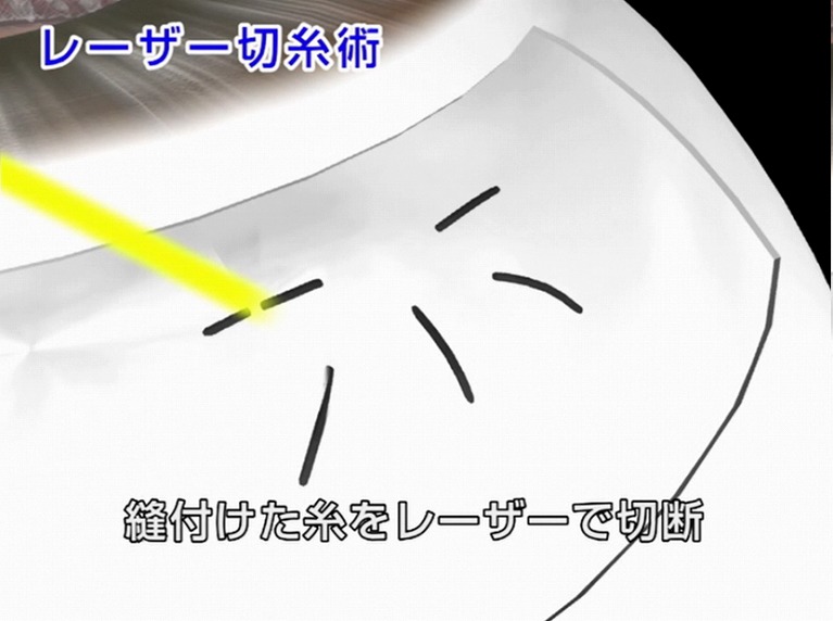 繊維柱帯切除術とは