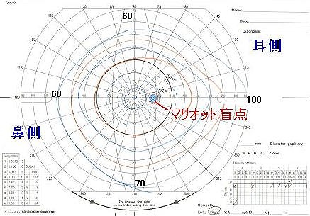 ゴールドマン視野計(動的計測)