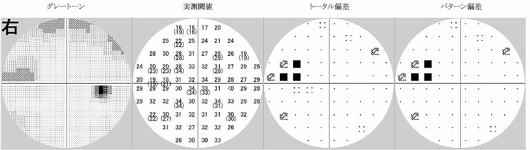 ハンフリー視野計、オプトス視野計(静的計測)