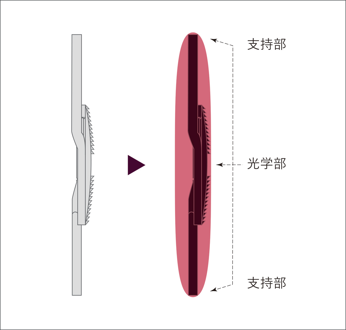 Tri-Fix 3点固定構造による優れた眼内安定性を支える設計